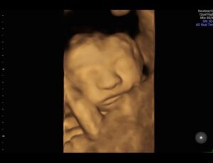 Bellybaloo- A New Way Of Seeing Your Ultrasounds!